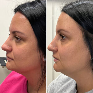 Before and after photo of patient after being treated with morpheus8