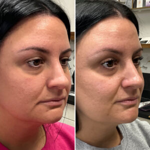 Before and after photo of patient after being treated with morpheus8