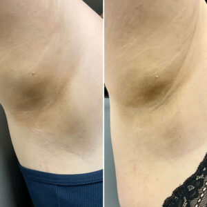 Before and after photo of patients armpit after being treated with morpheus8