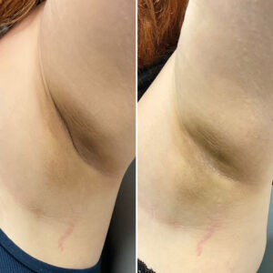 Before and after photo of patients armpit after being treated with morpheus8
