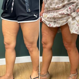Before and after photo of patient's legs after being treated with morpheus8