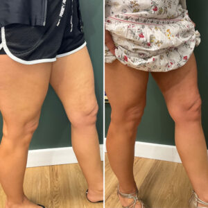 Before and after photo of patient's legs after being treated with morpheus8