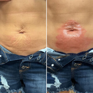 Before and after photo of patient's navel and lower belly after being treated with morpheus8