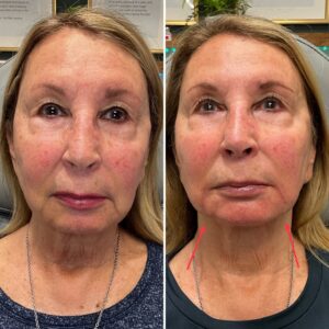 Before and after photo of patient after being treated with jawline dermal filler