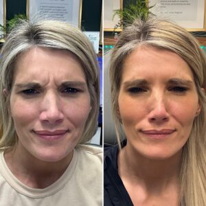 Before and after photo of a patient after being treated with wrinkle relaxer to the glabella