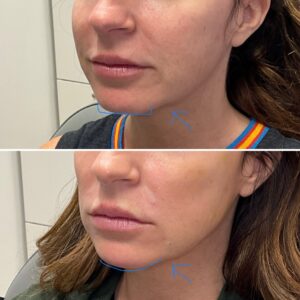 Before and after photo of patient after being treated with dermal filler in the chin