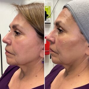 Before and after photo of patient after being treated with midface filler