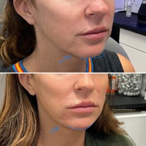 Before and after photo of patient after being treated with dermal filler in chin