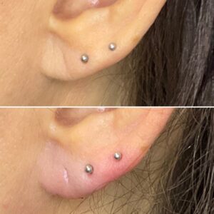 Before and after photo of patient after being treated with dermal filler in earlobes
