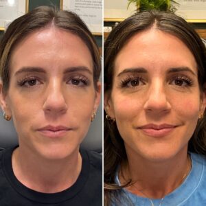 Before and after photo of patient after being treated with midface dermal filler