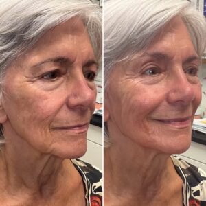 Before and after photo of patient after being treated with midface dermal filler