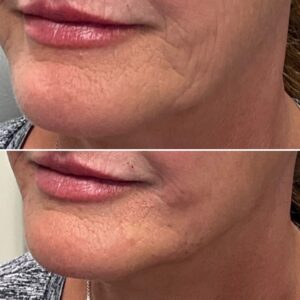 Before and after photo of patient after being treated with dermal filler in lower face