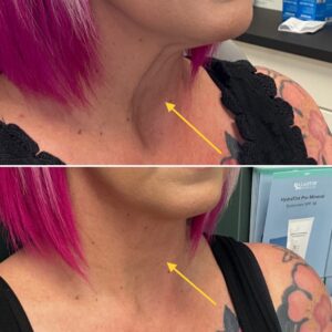 Before and after treatment with morpheus8 on the neck