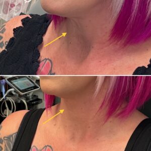 Before and after treatment with morpheus8 on the neck