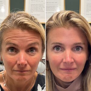 Before and after photos showing the results after treating forehead lines