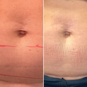 Before and after photo of a navel after treatment with morpheus8