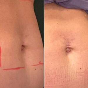 Before and after photo of a navel after treatment with morpheus8