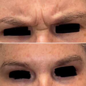 Before and after results showing treatment to the glabella