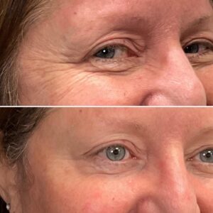 Before and after photos of a patient after crows feet being treated with wrinkle relaxer