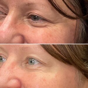 Before and after photos of a patient after crows feet being treated with wrinkle relaxer
