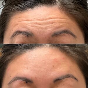 Before and after photos showing the results after treating forehead lines