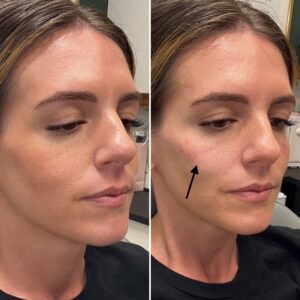 Before and after photo of patient after being treated with midface filler