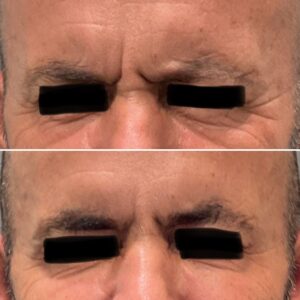Before and after results showing treatment to the glabella