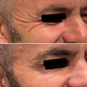 Before and after photos of a man after crows feet being treated with wrinkle relaxer