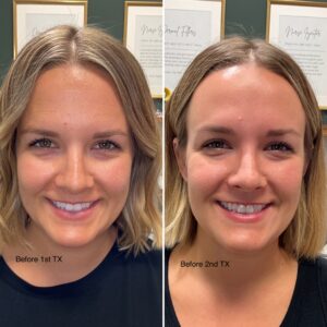 Before and after photos of a woman smiling showing the results of treating with wrinkle relaxer