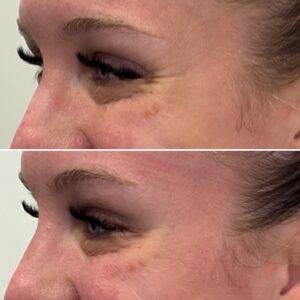 Before and after photos of a woman after crows feet being treated with wrinkle relaxer