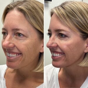 Before and after photos of a woman smiling showing the results of treating with wrinkle relaxer