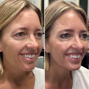Before and after photos of a woman smiling showing the results of treating facial lines with wrinkle relaxer