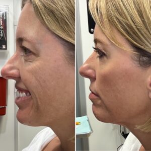 Side profile of a woman after being treated with wrinkle relaxer for facial lines